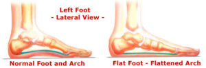 Disability Certificate for Flat Feet