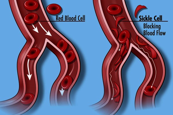 sickle cell disease: blood flow blocks