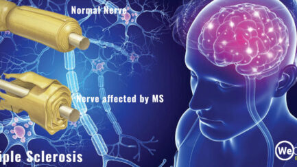 multiple sclerosis facts
