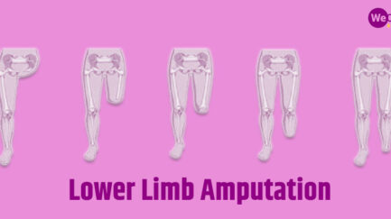 types of lower limb amputations