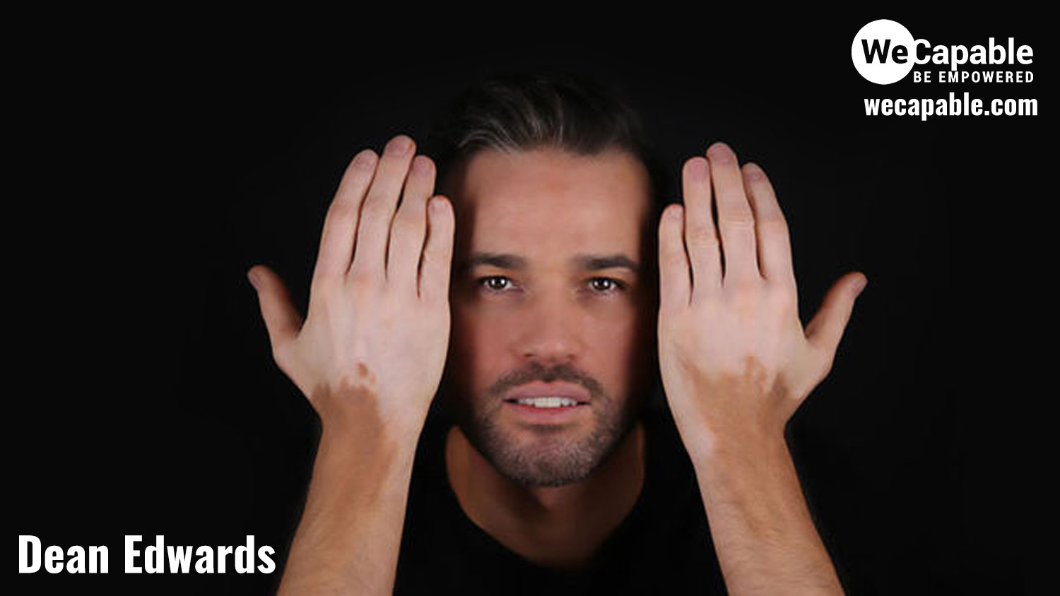 Photograph of Dean Edwards showing his hands with vitiligo patches
