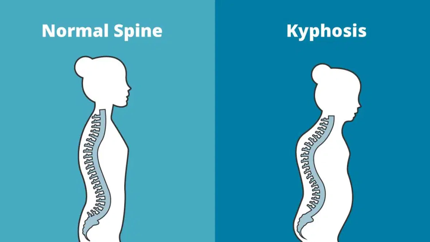 Illustration showing spine curvature in kyphosis