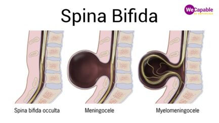 illustration showng types of spina bifida