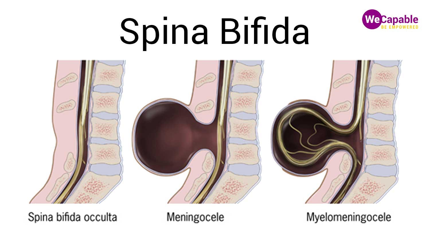 Spina Bifida: A Disability Caused due to Malformed Spinal Cord