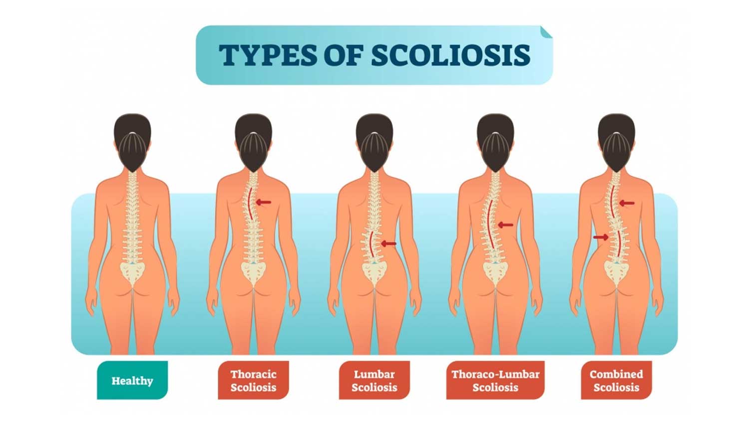 Illustration showing types of spine curvature in scoliosis