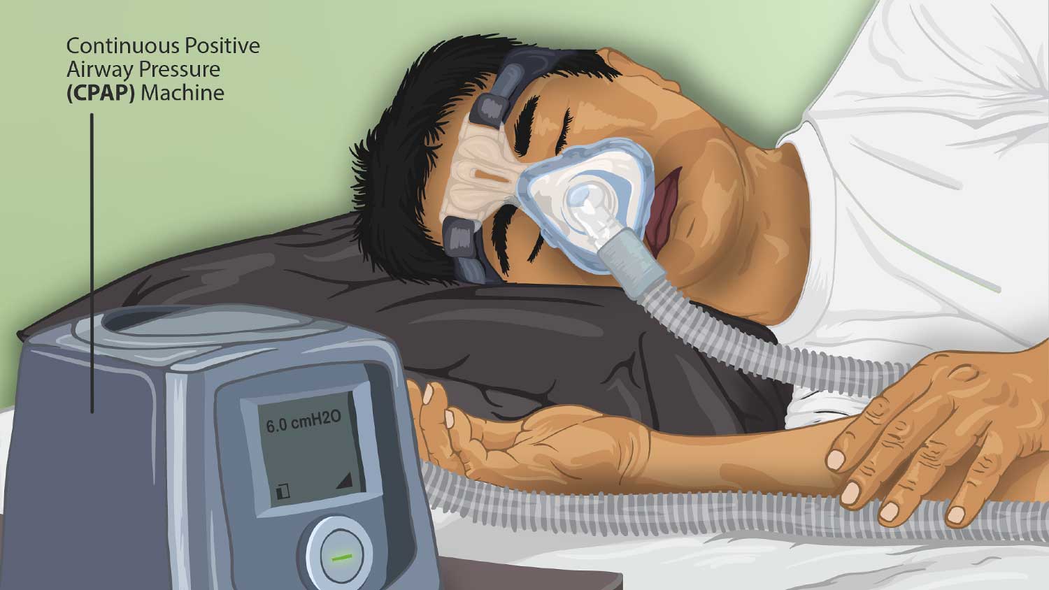 Sleep Apnea Symptoms Risk Factors And Complications 2286