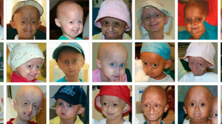 showing faces of people affected with progeria