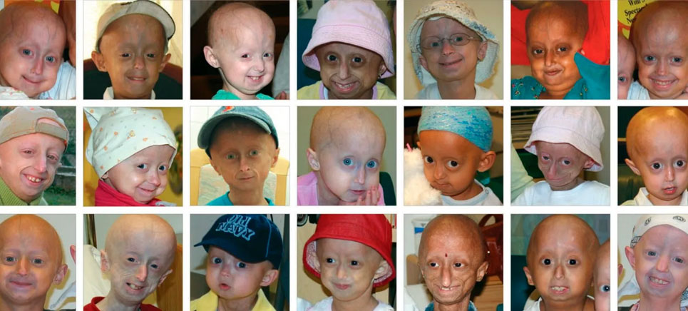 showing faces of people affected with progeria - a rare disease