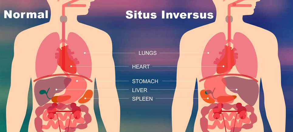 illustration showing effect of situs inversus