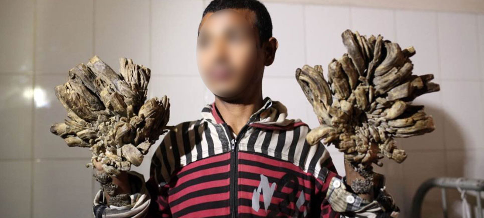 a person affected with treeman syndrome showing his hands