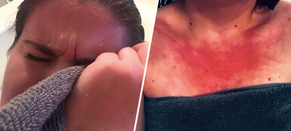 image shows a woman wish rashes on her body due to water allergy, a rare disease